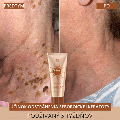 FRISSARC™ bieliaca a škvrny odstraňujúca pleťová maska – Prírodné zložky trvalo odstraňujú pigmentové škvrny, starecké škvrny, pehy a slnečné škvrny.